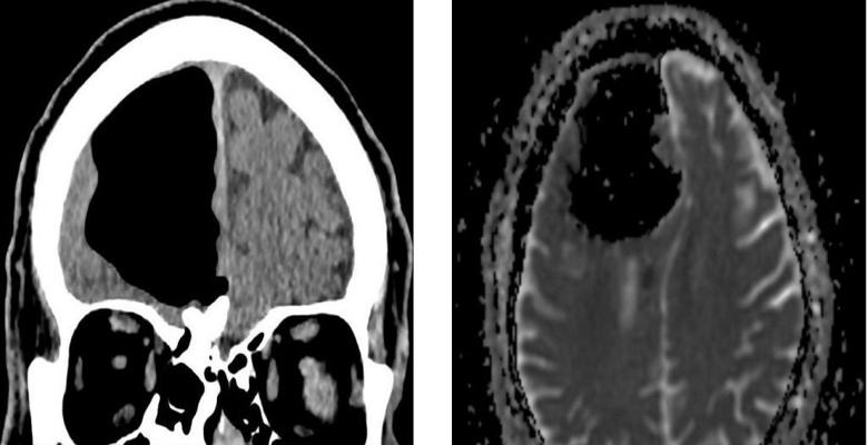 Irlantilaisen aivojen anomalia iski lääkäreitä