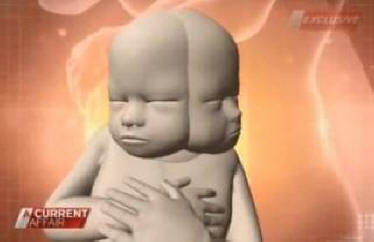 Australialainen on raskaana kaksipäisen lapsen kanssa. Video