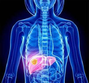 Rikkaat ja köyhät kärsivät erityyppisistä syöpistä