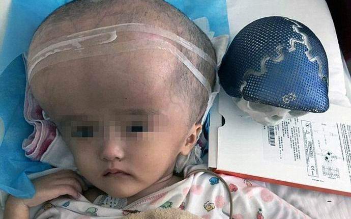 Tulostimelle painettu kallo istutettiin ensin miehelle.