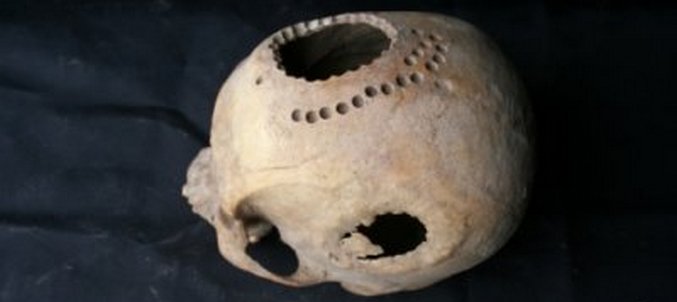 Muinaiset Siperian asukkaat tiesivät kuinka tehdä aivoleikkauksia