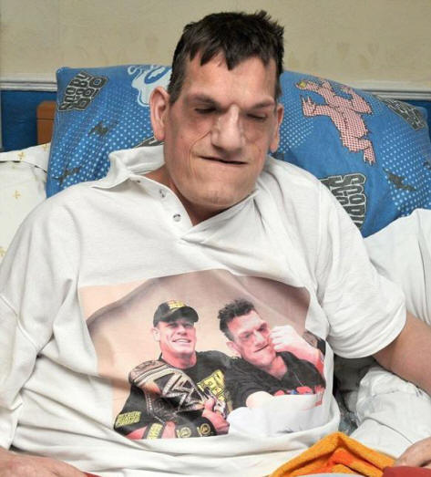 Proteus-oireyhtymän takia mies on kasvanut 240 senttimetriin