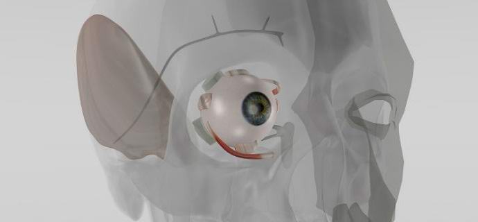 Saksalaiset keksivät implantin silmänsisäisen paineen säätelemiseksi.