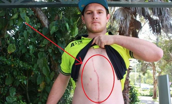 Hämähäkki sai aikaan liikkeen Australian vatsassa