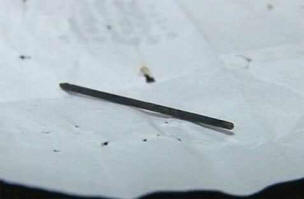 Akupunktio-neula kulki 40-vuotiaan miehen ruumiin läpi