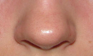 Kantasolujen hoidon jälkeen amerikkalainen nenä kasvoi