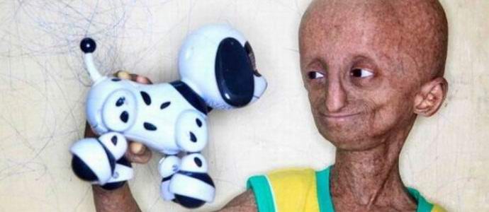 Harvinainen sairaus muutti teini-ikäisen muukalaiseksi