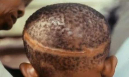 Liittyvätkö syntymämerkit väkivaltaiseen kuolemaan aiemmassa elämässä?