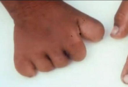 Liittyvätkö syntymämerkit väkivaltaiseen kuolemaan aiemmassa elämässä?