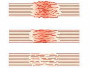 Biologisen kahvan avulla kaikki kudosvauriot voidaan parantaa nopeasti