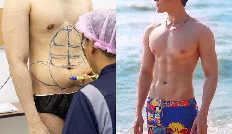 Thaimaan sairaala antaa rasvapotilaille ilmeisen paineistetun lehdistön