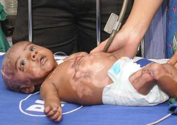 Toinen lapsi kärsii spontaanista palamisesta intialaisnaisen kohdalla