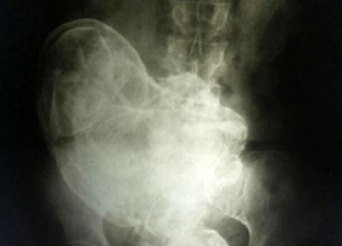 Brasiliassa 44-vuotias nainen kantoi kuollut vauva itsensä sisällä.