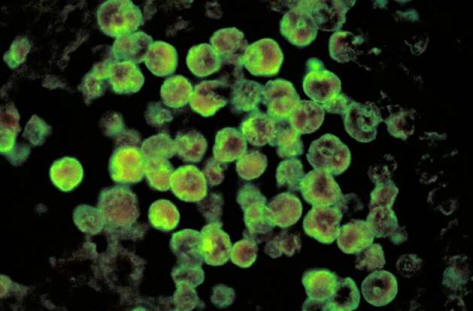 Louisianassa vesi on saastunut aivojen syövän amebien avulla.