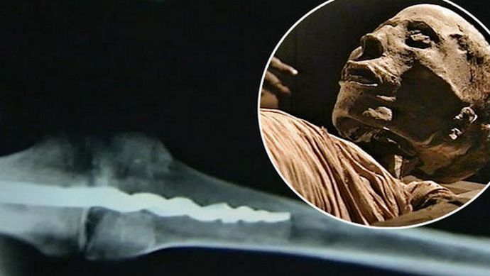 Muumiosta löydettiin modernin mallin ortopedinen tappi