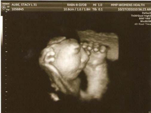 Yhdysvalloissa selittämättä kasvavat raskaustapaukset, joissa sikiö on harvinainen epämuodostunut