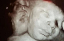 Kaksipäinen tyttö syntyi Yhdysvalloissa