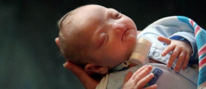 USA: ssa syntyi lapsi, jolla oli harvinainen poikkeavuus