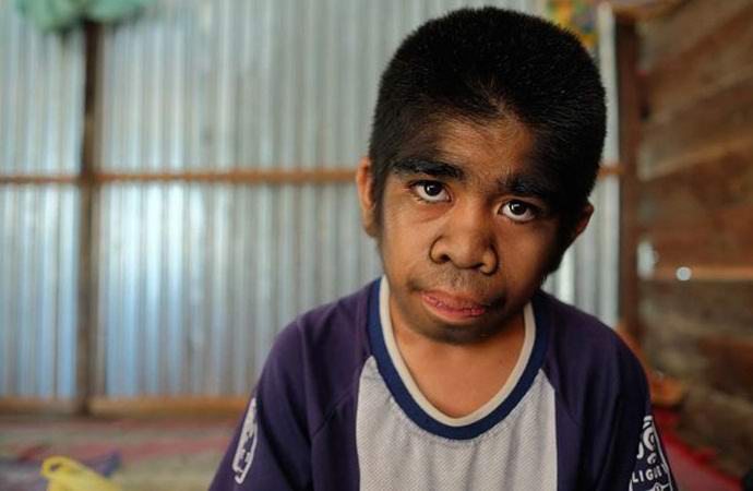 Karvainen poika, jolla on ihmissusi-oireyhtymä, kieltäytyy hoidosta