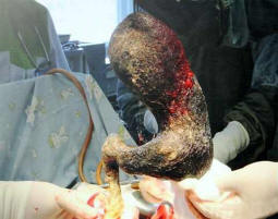 Lääkärit vetivät neljä kiloa hiuksia pölynimuritytöltä